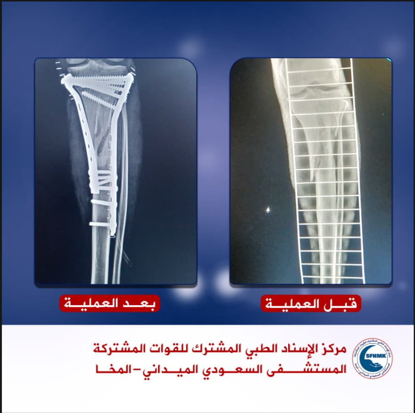 عملية تثبيت كسر متعدد اسفل الركبة